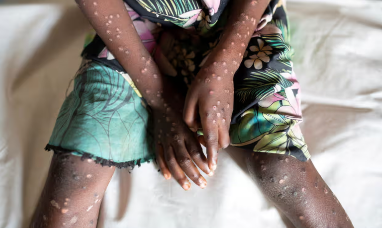 أفريقيا تشهد حالات إصابة متزايدة بالمرض