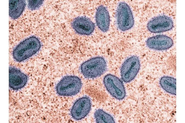 جدري القرود يثير القلق عالميا