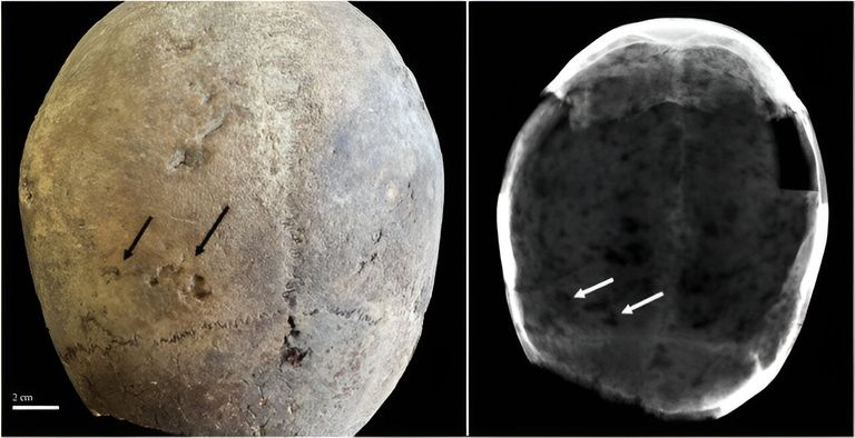 بقايا الأدمغة التي تم تحليلها في الدراسة 