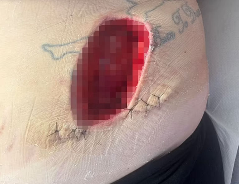 موضع إصابة السيدة البريطانية التهاب اللفافة الناخر يحدث عندما تدخل البكتيريا الجسم من خلال جرح أو قطع صغير