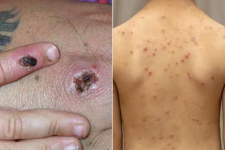 جدري القرود يهدد العالم