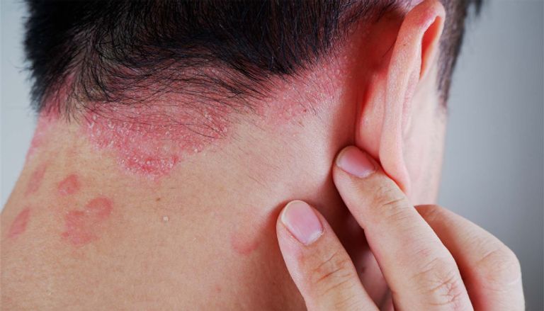 أسباب مرض الصدفية كل ما يخص مرض الصدفية