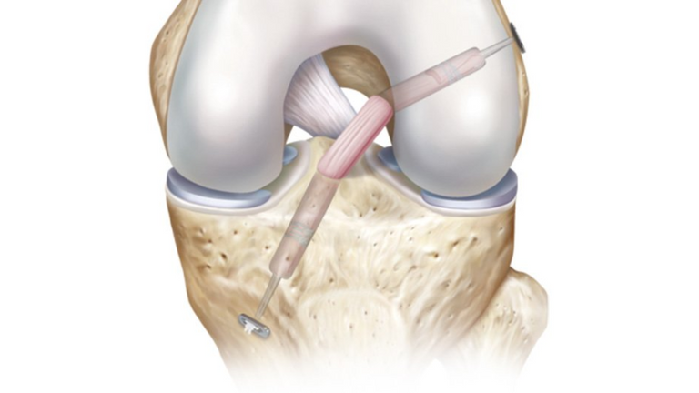 تطور كبير في مجال إعادة بناء العظام