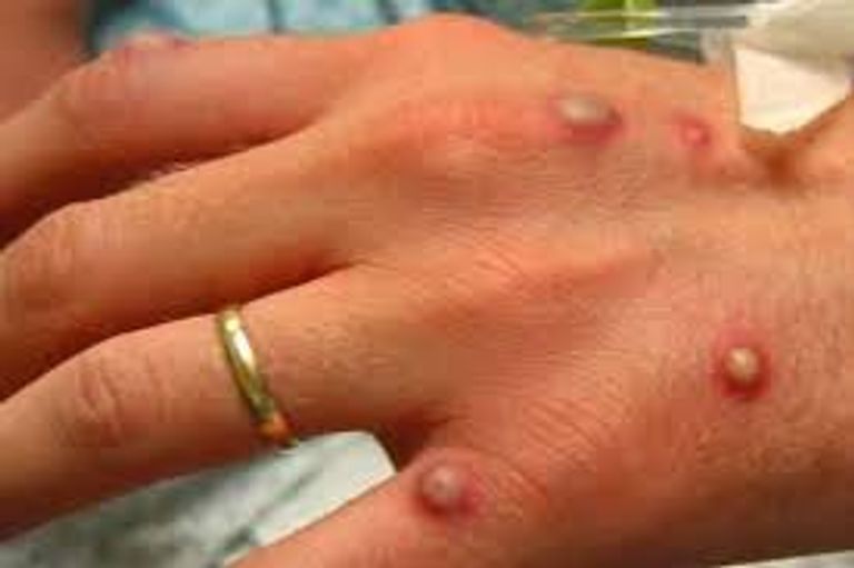 جدري القرود- أرشيفية