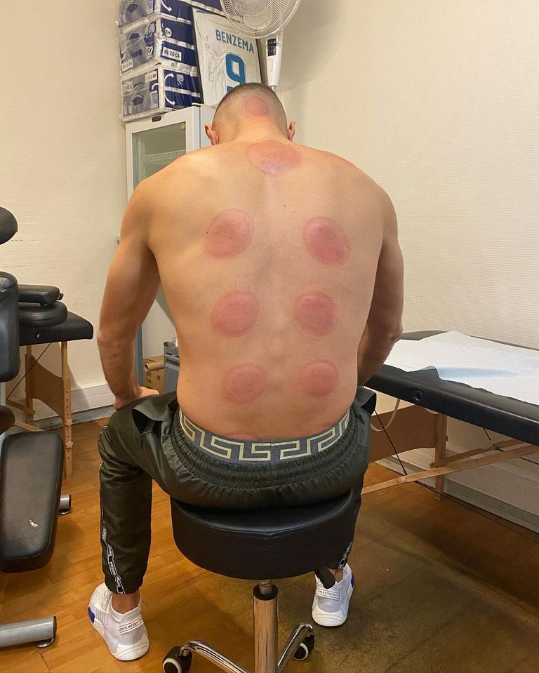 العلاج بالحجامة