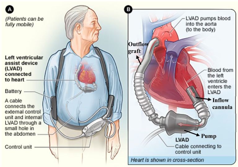 جهاز يعالج القلب