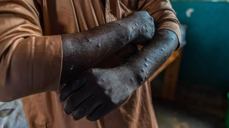 اكتشاف أول حالة إصابة بسلالة جديدة من فيروس جدري القرود في فرنسا