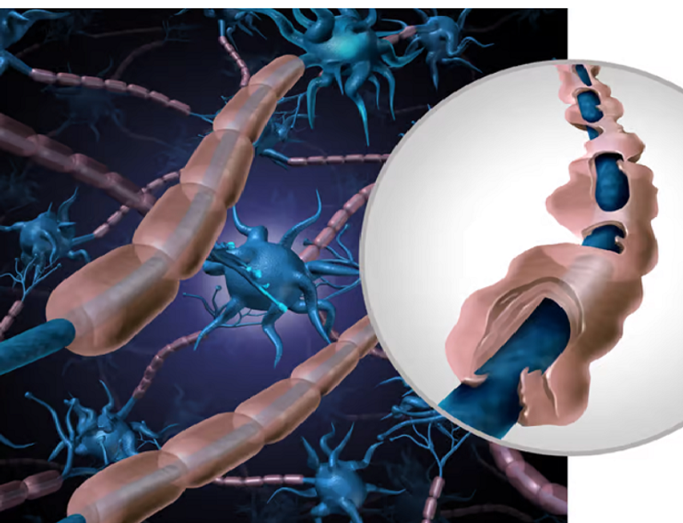 التصلب المتعدد يحدث بسبب تآكل غلاف الميالين المحيط بالخلايا العصبية