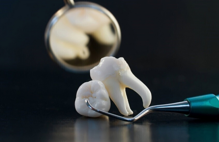 قلع أضراس العقل