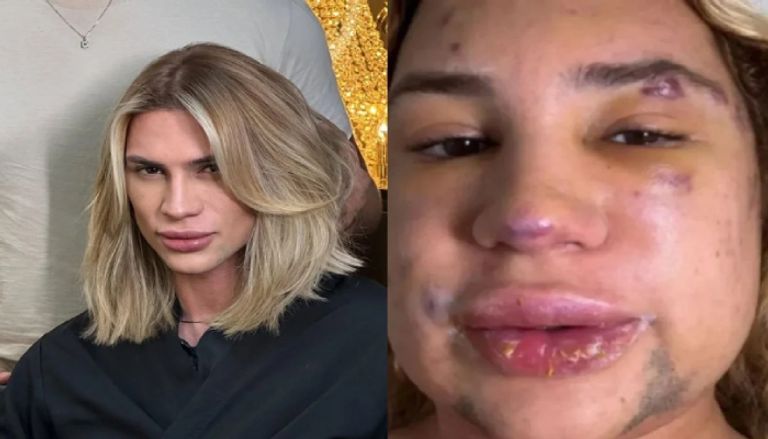 وفاة مؤثر برازيلي بعد خضوعه لعملية تجميل وفاة مؤثر برازيلي بعد خضوعه لعملية تجميل