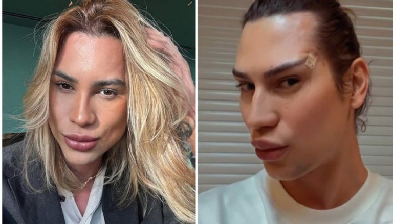 وفاة مؤثر برازيلي بعد خضوعه لعملية تجميل
