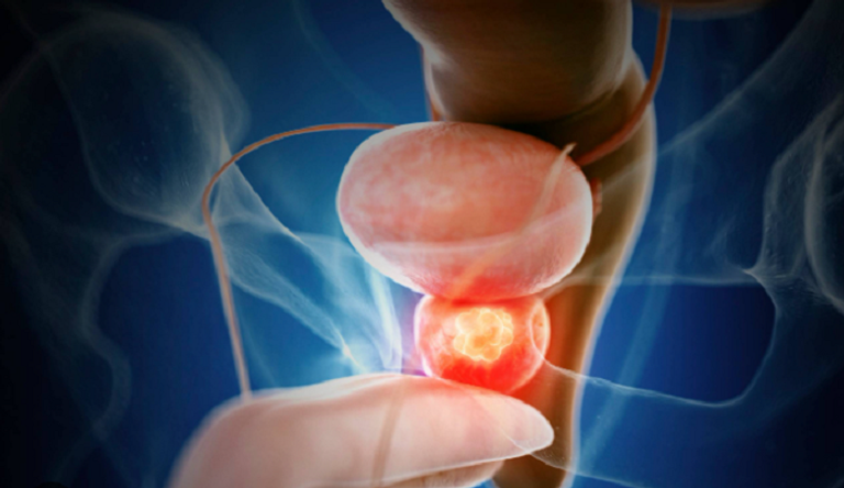 تجربة أمريكية كبرى تختبر سلاحا ثلاثيا ضد سرطان البروستاتا المتقدم