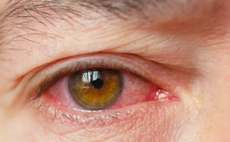 خبراء ينحصون بتدخلات وقائية بدون أدوية لعلاج جفاف العين