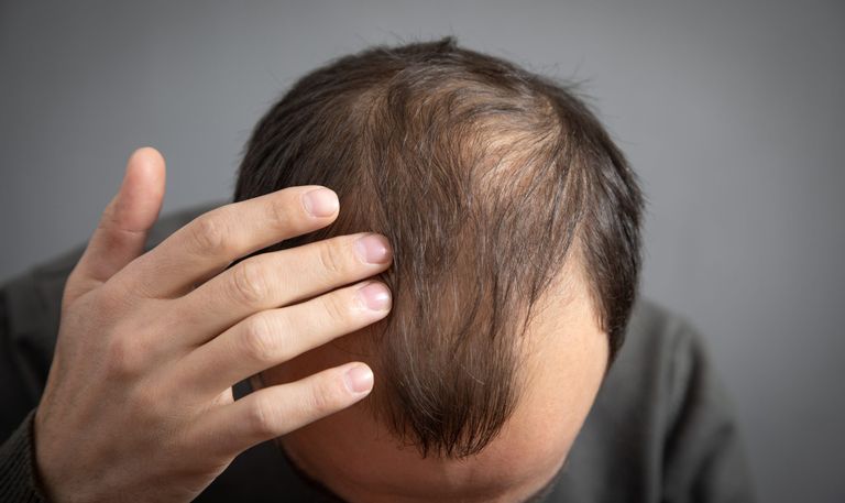  مكون شائع في الآيس كريم يمنع تساقط الشعر