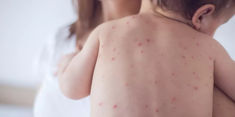 ارتفاع إصابات الحصبة في أمريكا ارتفاع إصابات الحصبة في أمريكا