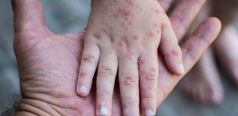 جدري الماء - تعبيرية