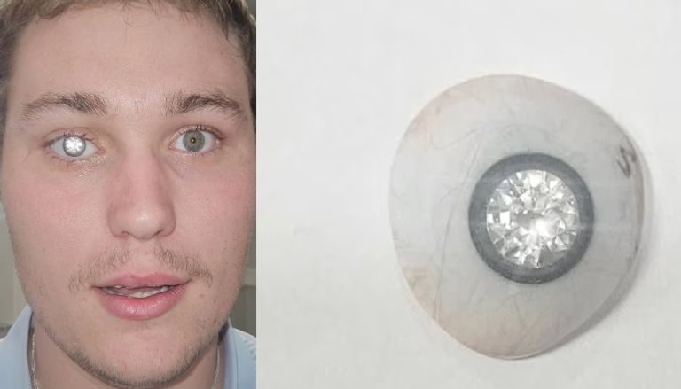 عين صناعية من الألماس بقيمة مليوني دولار عين صناعية من الألماس بقيمة مليوني دولار