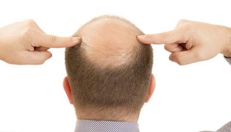 علماء يقتربون من حل جذري للصلع