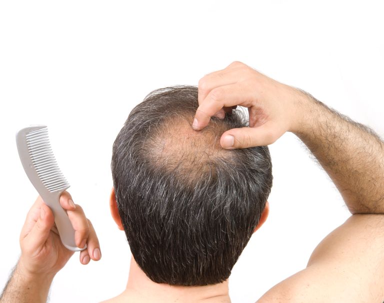 علماء يقتربون من حل جذري للصلع