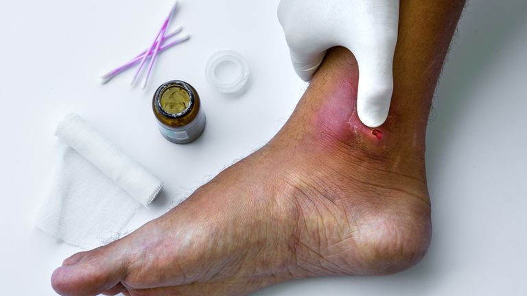 علاج تجريبي ينهي مشكلة جروح السكري المزمنة