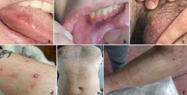 كشف الخريطة الجينية لمرض بهجت في مصر وتونس والمغرب