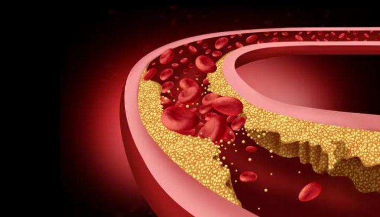 علاج جيني يخفض الكوليسترول الضار للنصف