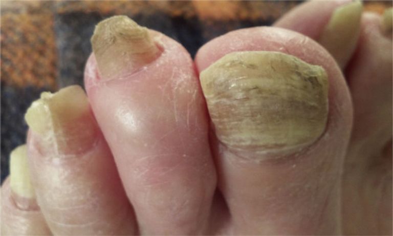 مرضى الأظافر المصابة المتصلبة قد يحصلون قريبا على علاج ثوري