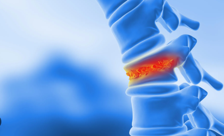 أمل جديد لعلاج الكسور دون جراحة قاسية