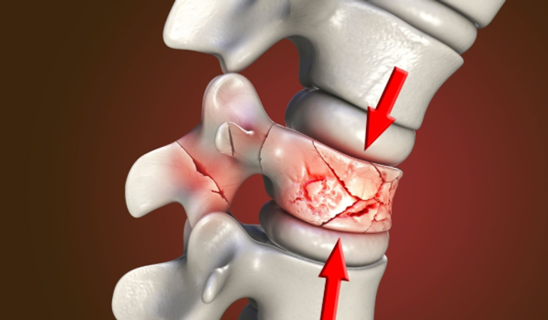 أمل جديد لعلاج الكسور دون جراحة قاسية