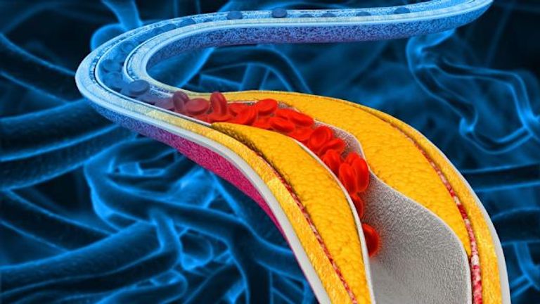 الدواء الجديد يخفض الكوليسترول “الضار” بنسبة تصل إلى 60%