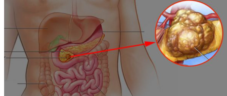 أمل جديد لعلاج سرطان البنكرياس بـ"الرنا المرسال"