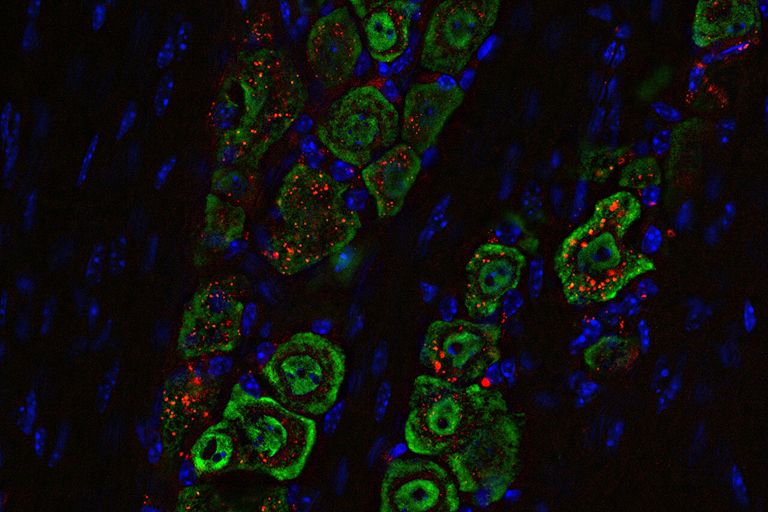 ابتكار علاج غير جراحي لأحد أخطر الأورام الدماغية 