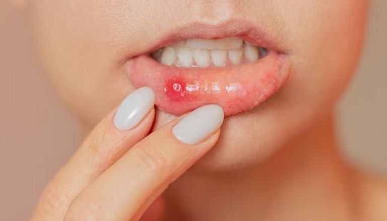 تقرحات الفم المتكررة قد تنذر بأمراض خطيرة