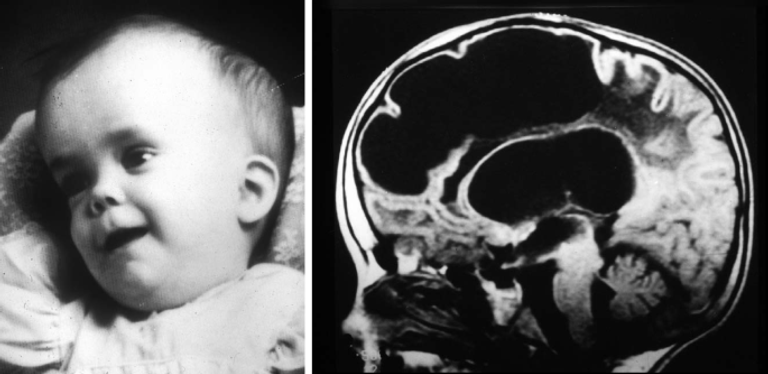 مرض إلكسندر، اضطراب وراثي يؤدي تدريجيًا إلى تدهور وظائف الدماغ