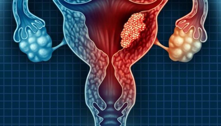 سرطان عنق الرحم