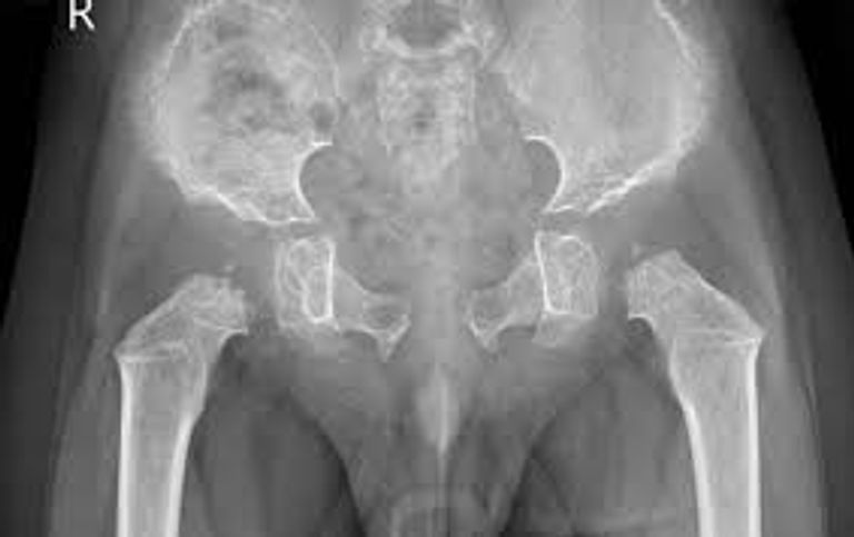 مرض موركيو يسبب مشكلات متعددة في القلب والعينين والمفاصل