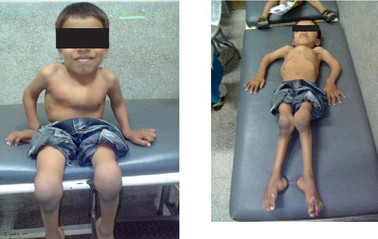 مرض موركيو يسبب مشكلات متعددة في القلب والعينين والمفاصل