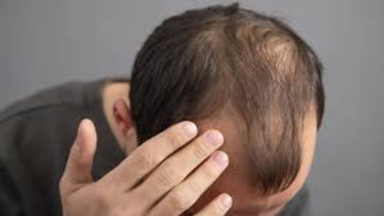 التوتر يوقظ خلايا قاتلة داخل الرأس تتسبب في فقدان الشعر