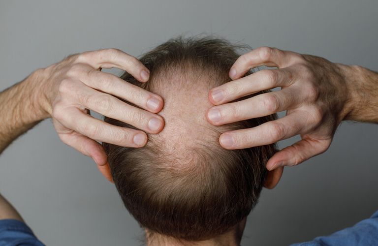 تقدم دوائي لعلاج الصلع