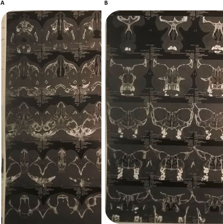 أول إصابة بالمرض غير مرتبطة بزواج الأقارب