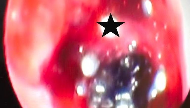 حالة نادرة لمريضة سورية تعاني من ورم في الجيوب الأنفية 