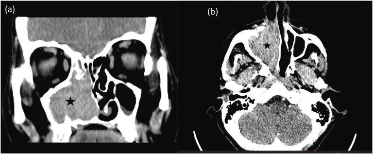 حالة نادرة لمريضة سورية تعاني من ورم في الجيوب الأنفية 
