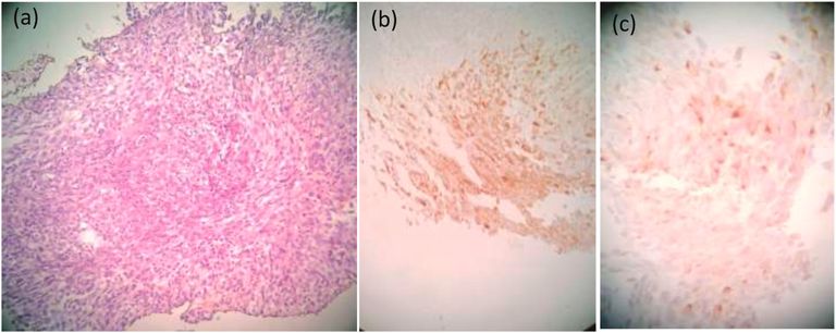 حالة نادرة لمريضة سورية تعاني من ورم في الجيوب الأنفية 