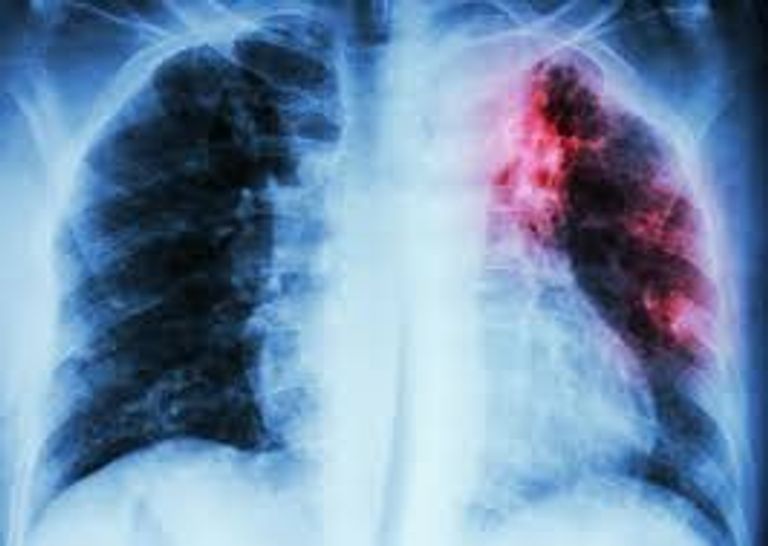 فريق من العلماء كشف عن تغييرات جينية مخفية داخل بكتيريا السل.