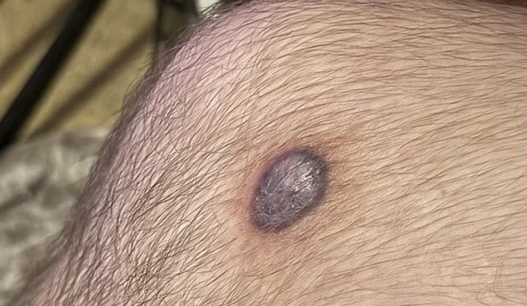 لدغة العنكبوت تسببت في تكون ثقب متعفن في ساق المراهق البريطاني