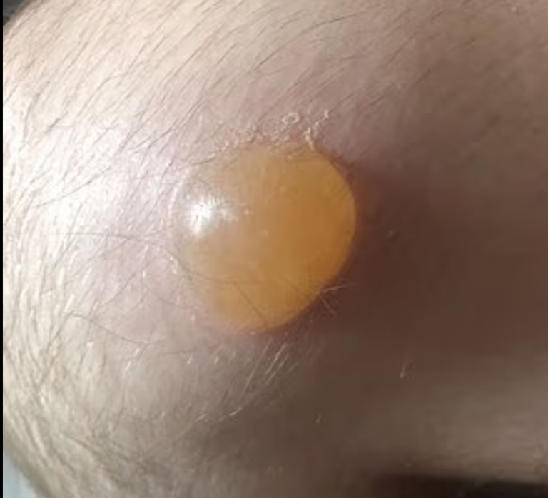 لدغة العنكبوت تسببت في تكون ثقب متعفن في ساق المراهق البريطاني