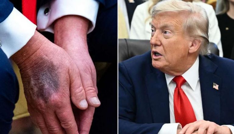 كدمات على يد ترامب