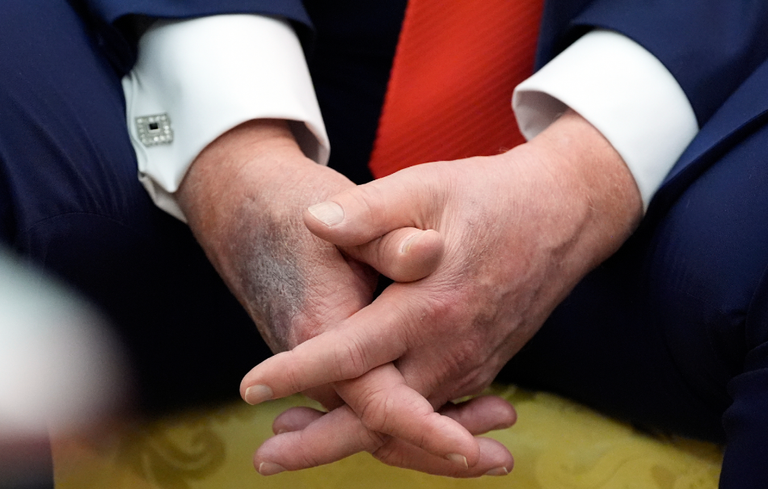 كدمات على يد ترامب