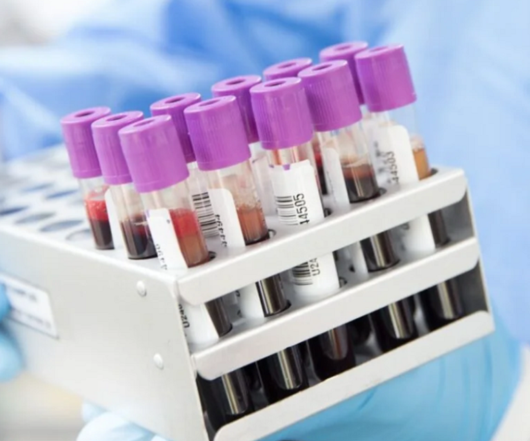 فحوصات لدماء ملوثة بعنصر اليورانيوم