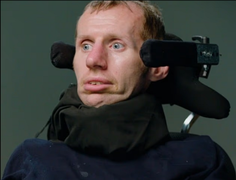 اختبار دم جديد يكتشف مرض العصبون الحركي مبكرا 